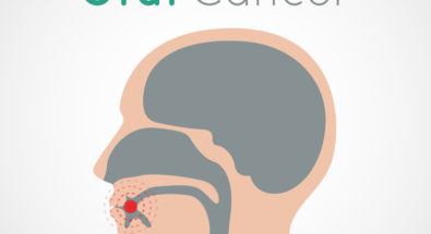 Info graphic image of oral cancer