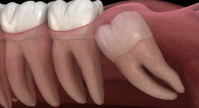 Image of wisdom tooth before extraction